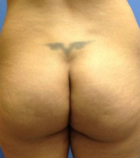 Липосакция ягодиц - фото до