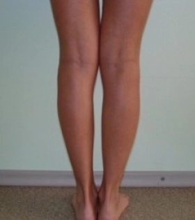 Липосакция ног - фото до