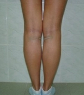 Липосакция ног - фото після