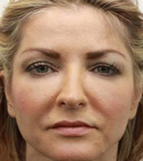 Безопераційна 3D-підтяжка шкіри в Одесі - фото до