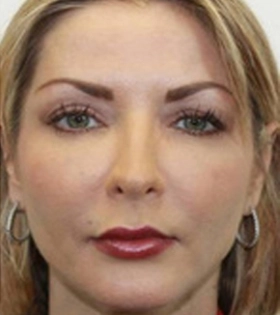 Безопераційна 3D-підтяжка шкіри в Одесі - фото після