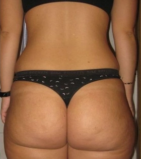 Липолиз и подтяжка кожи VelaShape - фото до