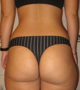 Липолиз и подтяжка кожи VelaShape - фото після