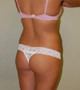 Липолиз и подтяжка кожи VelaShape - фото до