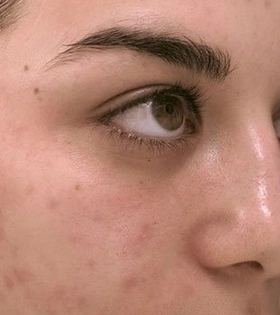 Атравматична глибока чистка обличчя в Одесі - фото до