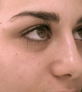 Атравматична глибока чистка обличчя в Одесі - фото після