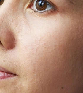 Ультразвукове чищення обличчя в Одесі. - фото до