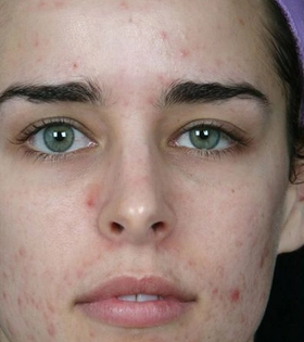 Комбинированная чистка лица в Одессе - фото до