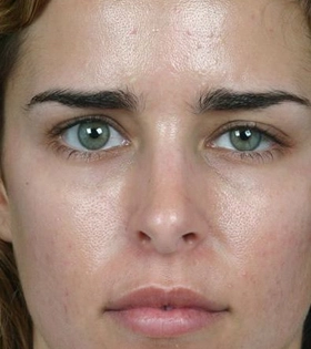 Комбинированная чистка лица в Одессе - фото после