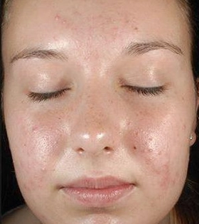 Миндальный пилинг - фото до