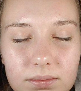 Миндальный пилинг - фото після