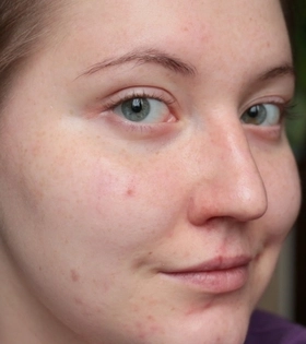 Миндальный пилинг - фото до