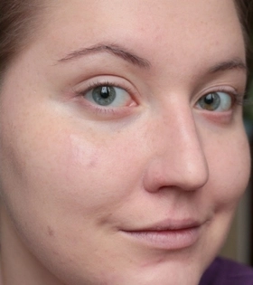 Миндальный пилинг - фото після