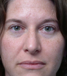 Пилинг Травяной Herbs2Peel - фото до