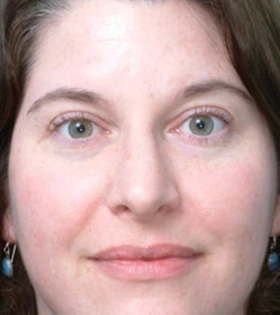 Пилинг Травяной Herbs2Peel - фото після