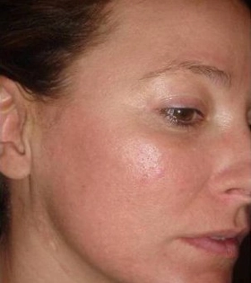 Пилинг Джесснера - фото після