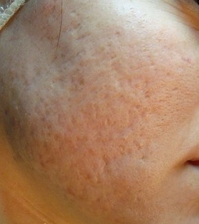 Пилинг ТСА - фото до