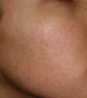 Пилинг ТСА - фото після