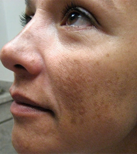 Пилинг Феруловый - фото до