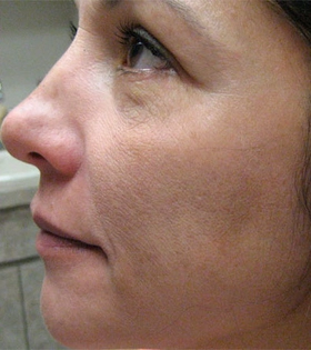 Пилинг Феруловый - фото після