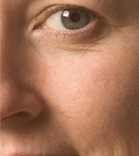 Пилинг Феруловый - фото до