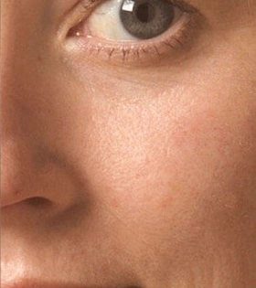 Пилинг Феруловый - фото після