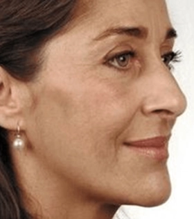 Карбокситерапия - фото до