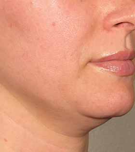 Ультразвуковой SMAS-лифтинг - фото до