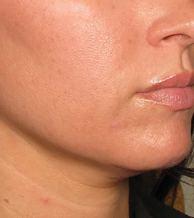 Ультразвуковой SMAS-лифтинг - фото після