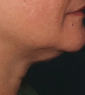 Ультразвуковой SMAS-лифтинг - фото до