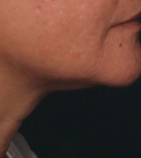 Ультразвуковой SMAS-лифтинг - фото після