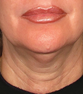 Ультразвуковой SMAS-лифтинг - фото до