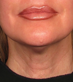 Ультразвуковой SMAS-лифтинг - фото після