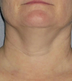 Ультразвуковой SMAS-лифтинг - фото до