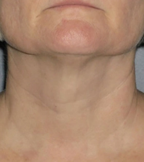 Ультразвуковой SMAS-лифтинг - фото після