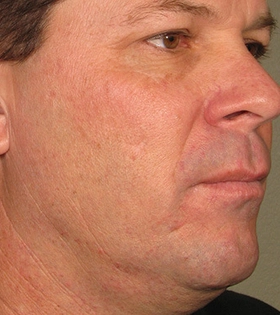 Ультразвуковой SMAS-лифтинг - фото до