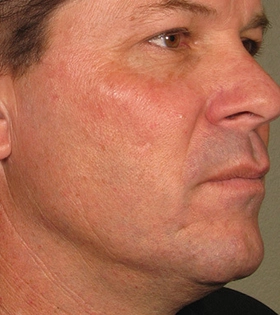 Ультразвуковой SMAS-лифтинг - фото після