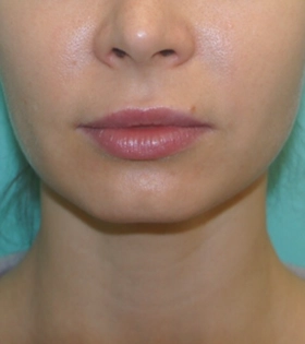 Контурна пластика підборіддя в Одесі. - фото до