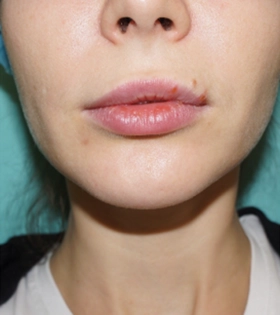 Контурна пластика підборіддя в Одесі. - фото після