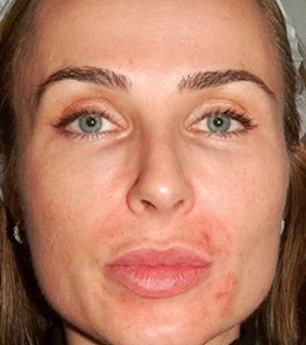 Контурная пластика скул - фото до