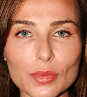 Контурная пластика скул - фото після