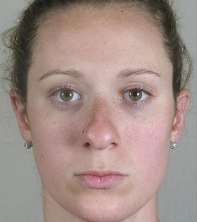 Контурная ластика носа филлерами - фото до