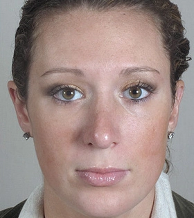 Контурная ластика носа филлерами - фото після