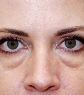 Корекція нососльозної борозни в Одесі. - фото до