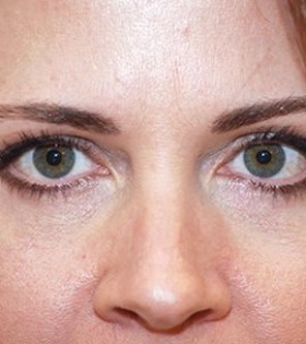 Корекція нососльозної борозни в Одесі. - фото після