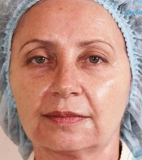 Корекція нососльозної борозни в Одесі. - фото до