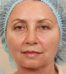 Корекція нососльозної борозни в Одесі. - фото після