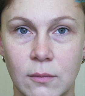 Корекція нососльозної борозни в Одесі. - фото до