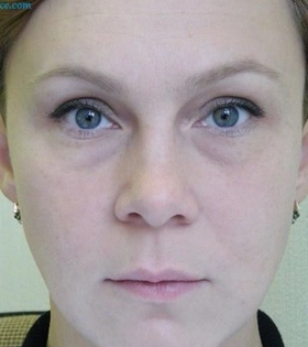 Корекція нососльозної борозни в Одесі. - фото після