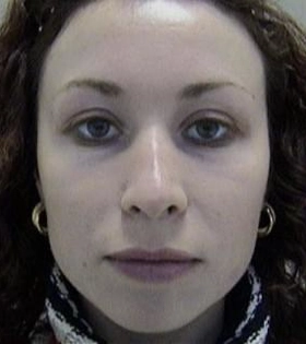 Ліпофілінг обличчя в Одесі - фото до